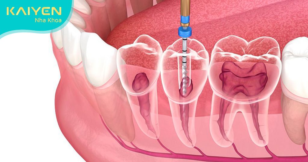 Điều trị tủy răng trước khi bọc răng sứ