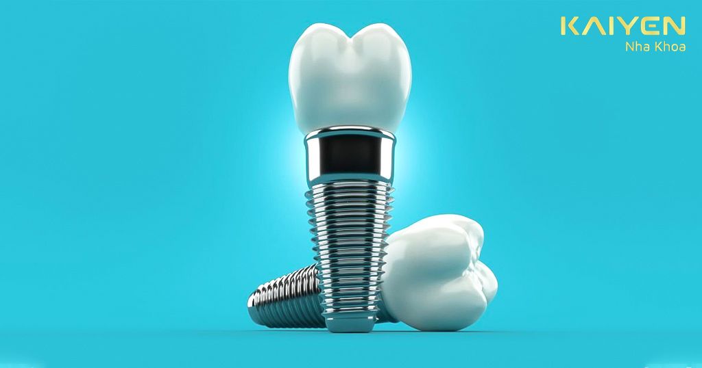 Trồng răng Implant Hàn Quốc giá bao nhiêu phụ thuộc vào nhiều yếu tố