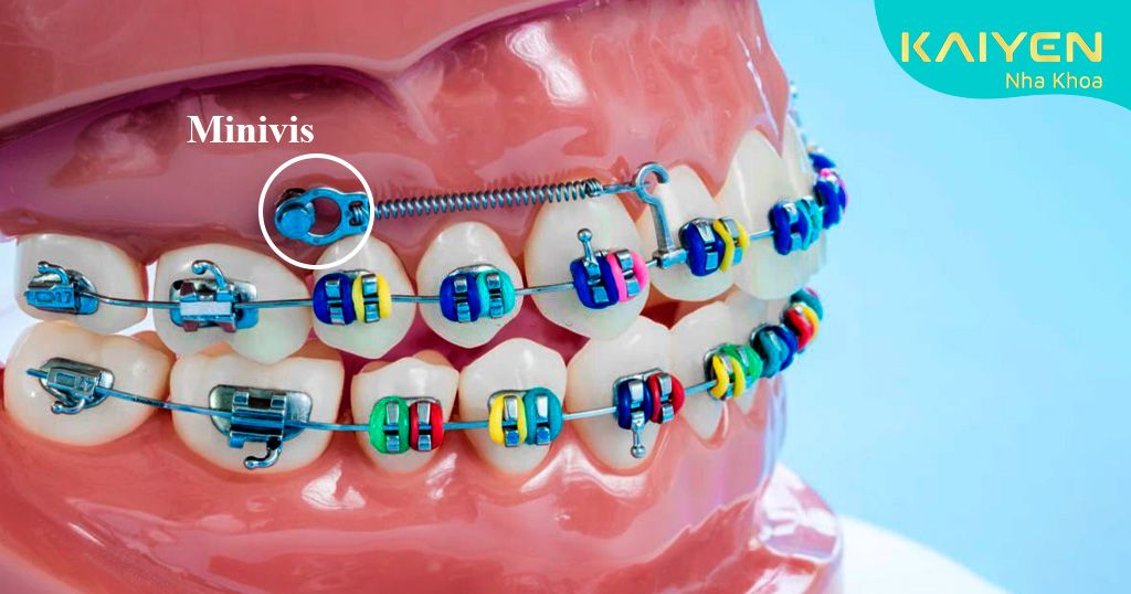 Sử dụng Minivis để đóng khoảng niềng răng