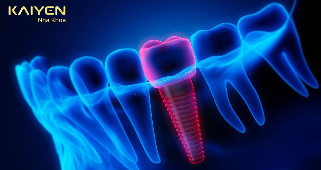 Hướng dẫn top 5 cách giảm đau sau cấy ghép Implant