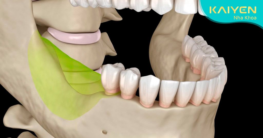 Sử dụng hàm giả không thể ngăn ngừa tiêu xương hàm