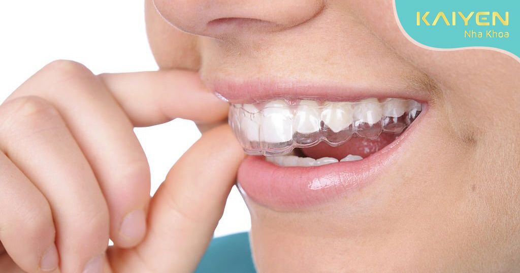 Niềng răng trong suốt Invisalign khắc phục các tình trạng răng hô