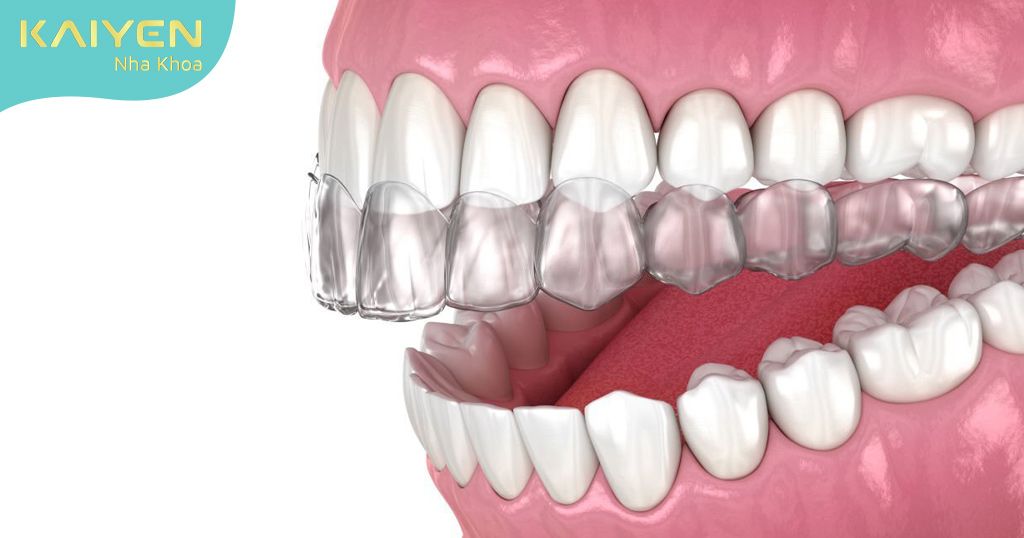 Niềng răng trong suốt Invisalign