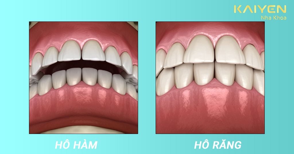 Nguyên nhân gây ra hô hàm, hô răng là gì?