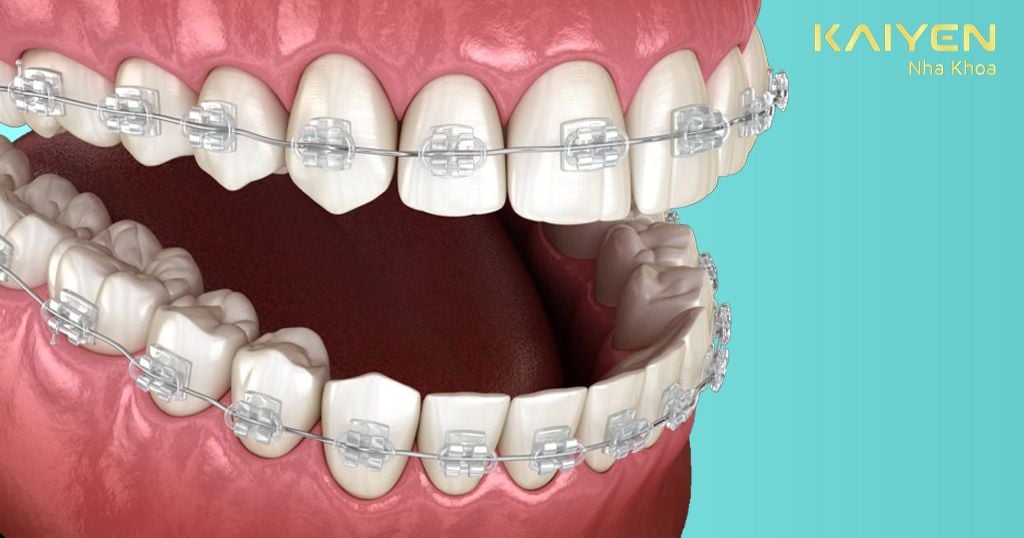 Điều trị hô răng bằng phương pháp niềng răng