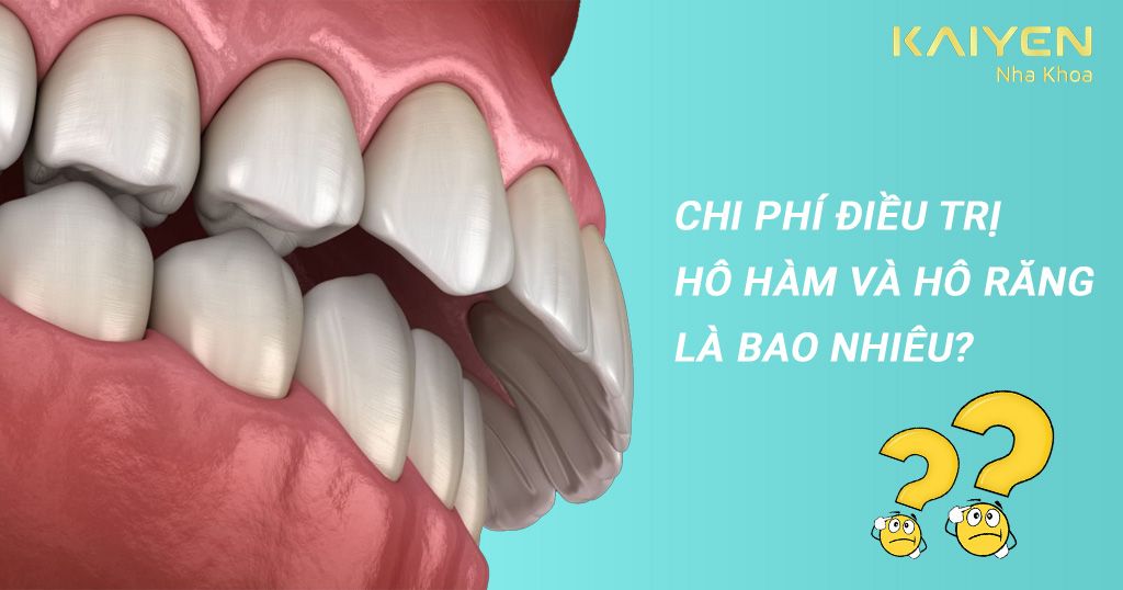 Hô hàm và hô răng: Cách phân biệt và phương pháp điều trị – Nha khoa ...