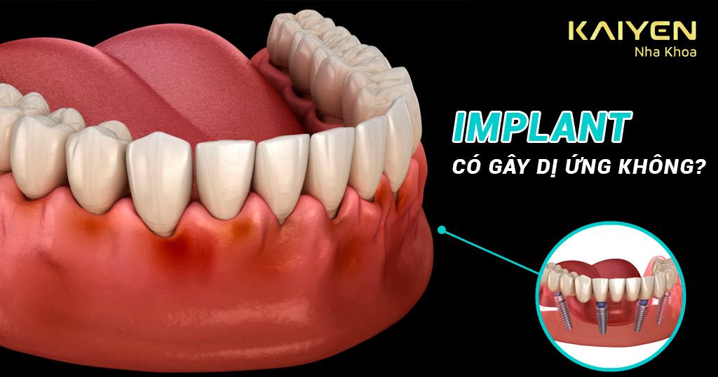 Trồng răng Implant có gây dị ứng không?