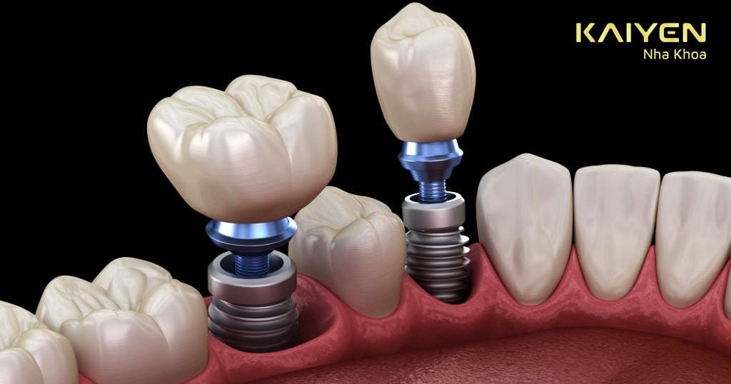 Nếu bạn dị ứng với Titanium thì bác sĩ có thể đổi sang loại Implant khác