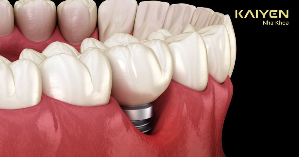 Nướu bị tụt sau khi cấy Implant