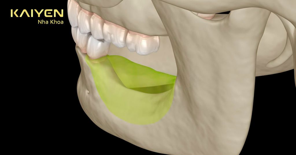 Răng Implant Mỹ giúp ngăn chặn biến chứng tiêu xương