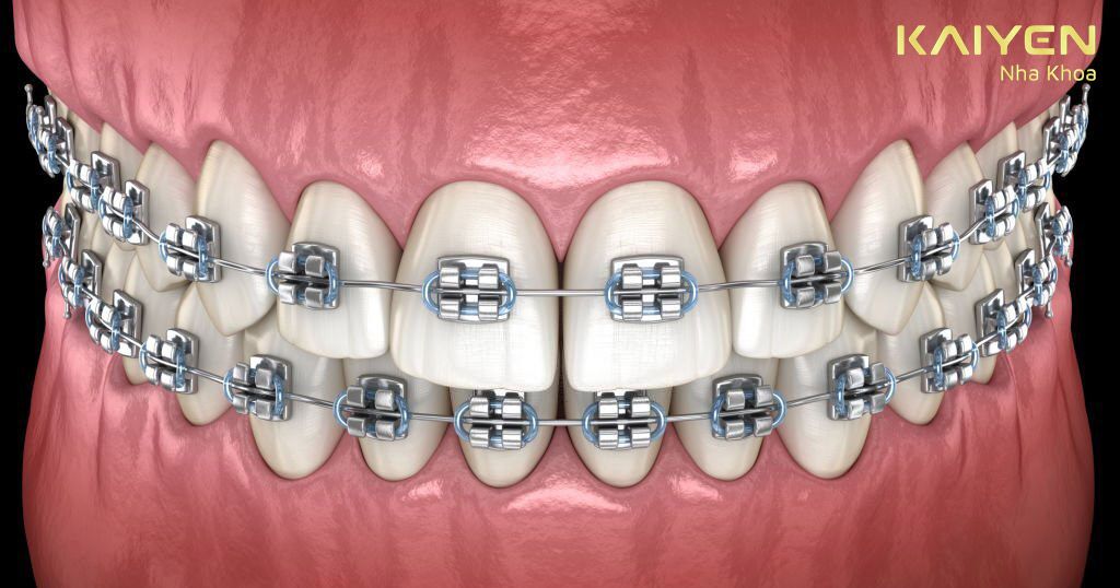 Dụng cụ chỉnh nha mắc cài giúp răng thẳng, đều và đẹp hơn