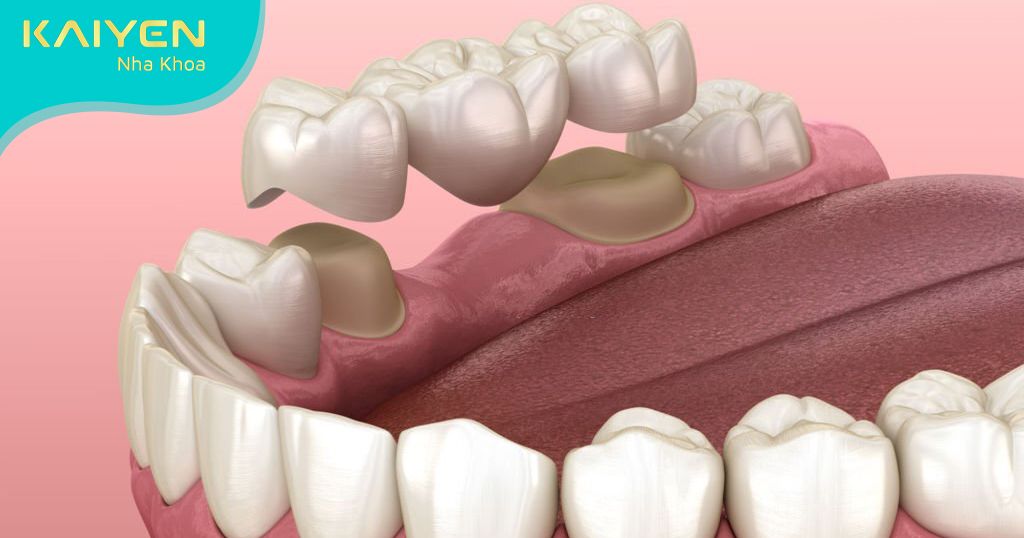 Khi nào nên bọc răng sứ? Tìm hiểu độ tuổi bọc răng sứ an toàn