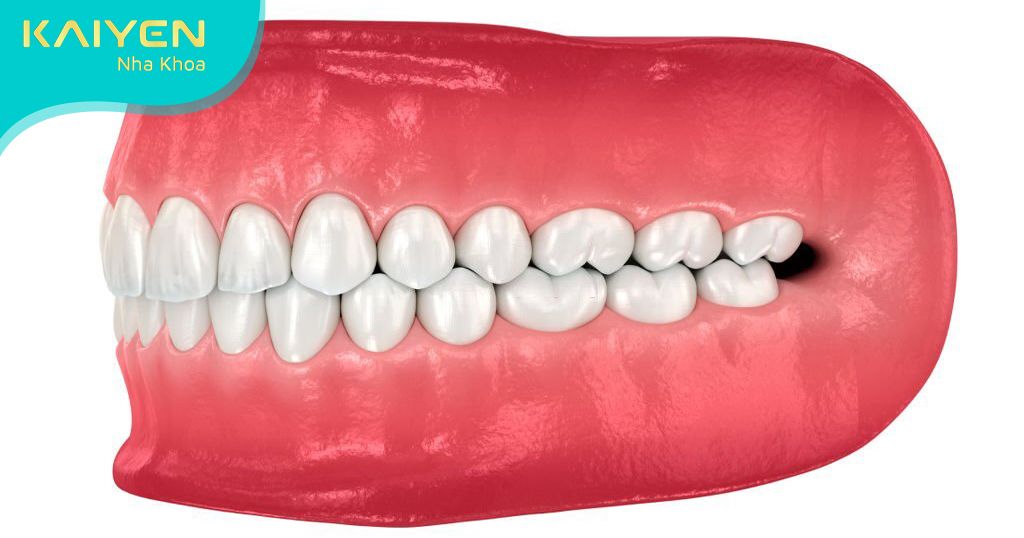 Độ tuổi bọc răng sứ phù hợp khi hàm răng phát triển hoàn thiện