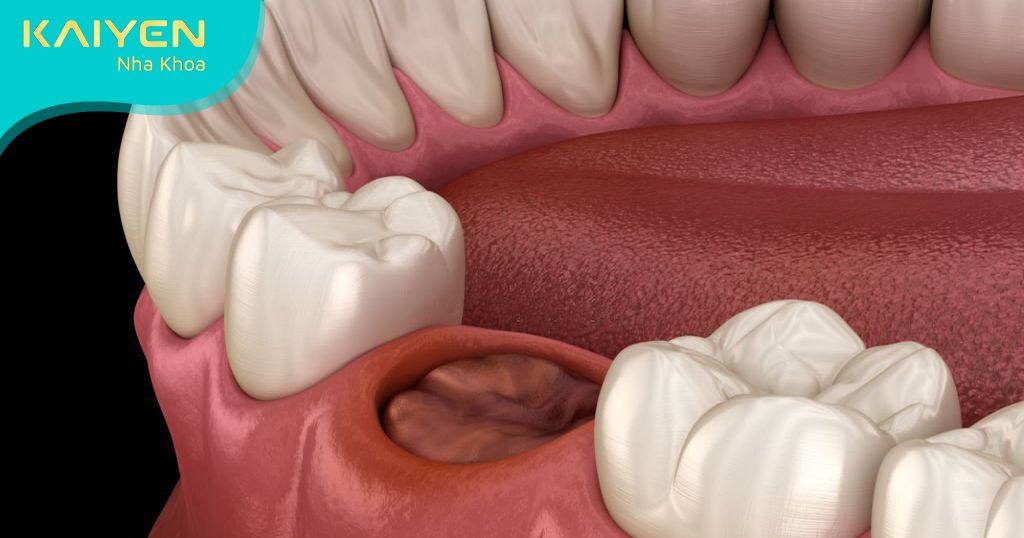 Bọc răng sứ chống chỉ định với người có sức khỏe răng miệng không ổn định