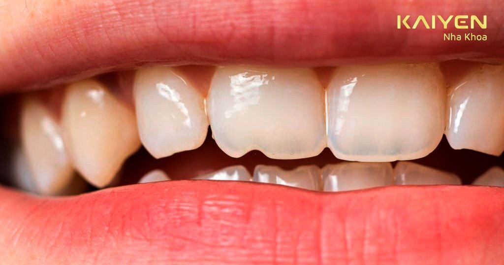 Răng bị sứt mẻ do không kịp thời điều trị khớp cắn đối đầu