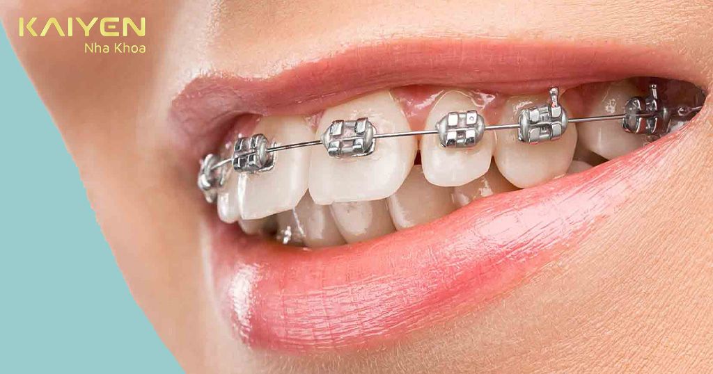 Hàm cắn sâu do răng có thể khắc phục bằng phương pháp niềng răng
