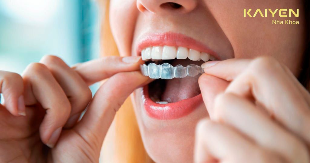 Niềng răng Invisalign có thể rút ngắn thời gian điều trị