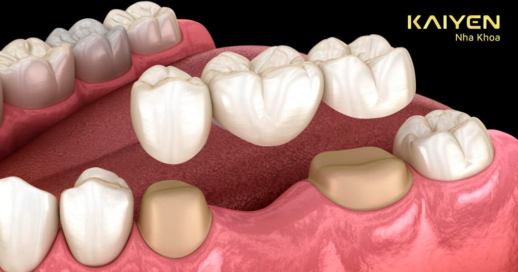 Làm cầu răng có bị tiêu xương do chỉ dựa vào lực nâng đỡ của 2 răng thật kế cận