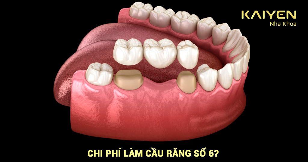 Làm cầu răng số 6 giá bao nhiêu?