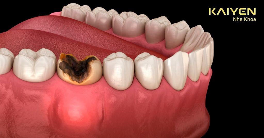 Điều trị dứt điểm răng bị sâu trước khi làm cầu răng