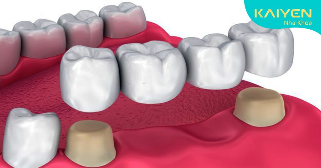 Sử dụng răng số 5 và 6 làm trụ đỡ khiến răng còn lại bị mất cân đối