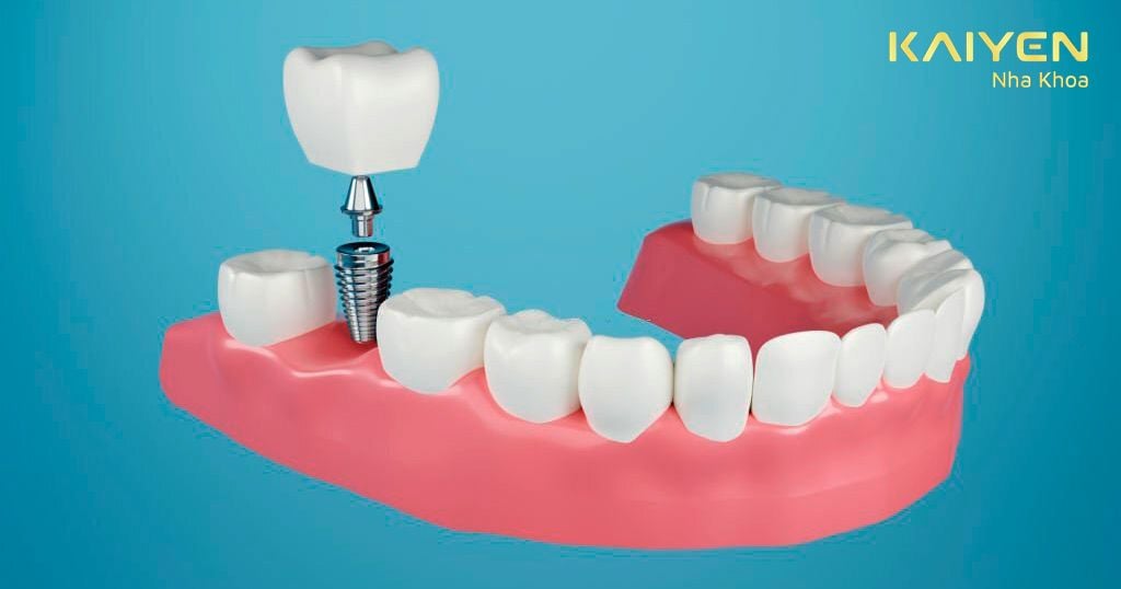 Cấy ghép Implant tại vị trí răng số 7