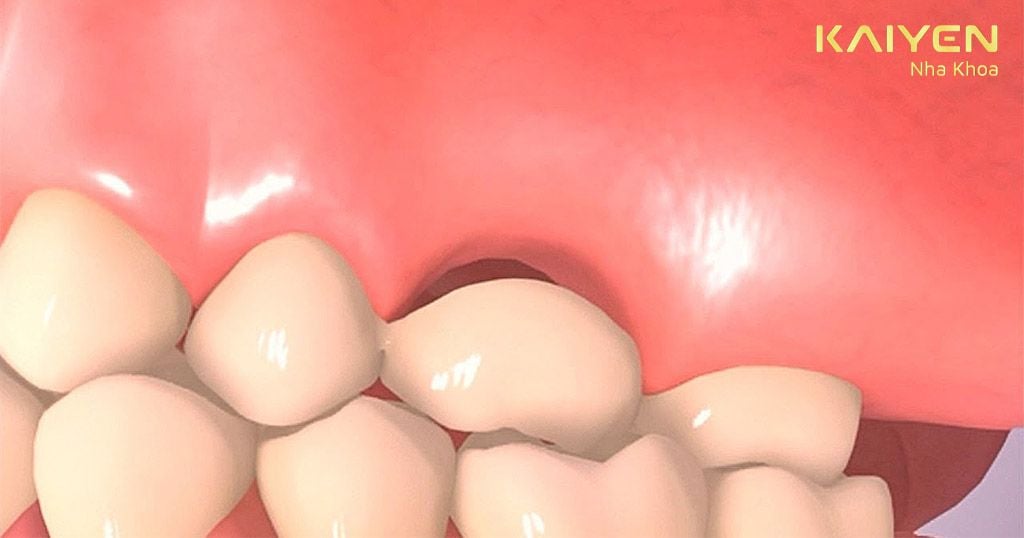 Cầu răng sứ bị hở nhịp gây tình trạng hôi miệng