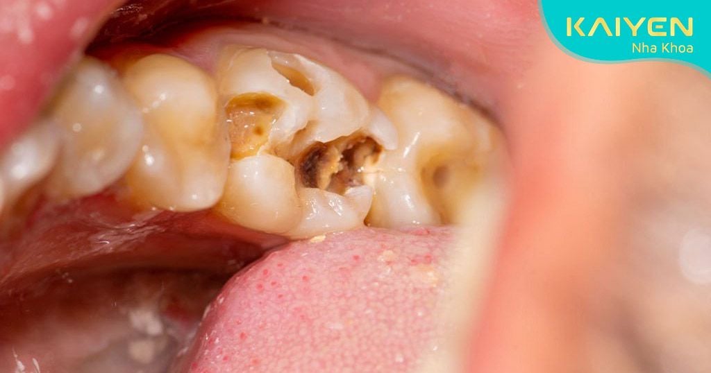 Bệnh lý sâu răng trước khi làm cầu răng sứ