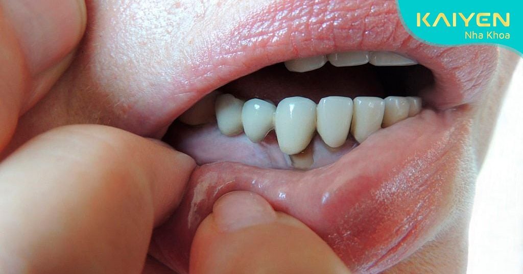 Cầu răng sứ bị hở chân răng gây giắt thức ăn