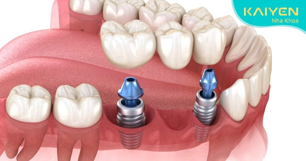 Trồng răng Implant – giải pháp ngăn ngừa biến chứng tiêu xương hàm