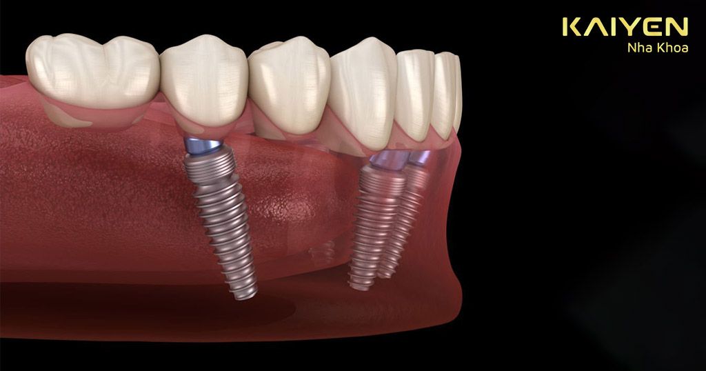 Đối tượng cần làm cầu răng sứ trên Implant?