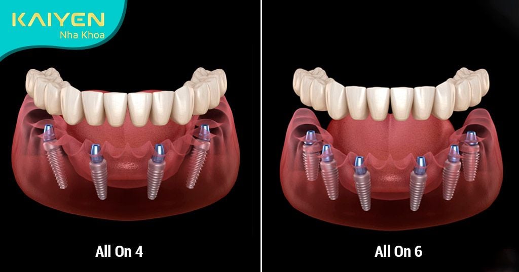 Trồng răng Implant toàn hàm All-on-4 và All-on-6