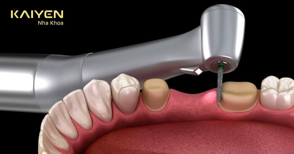 Kiểm soát tốt tỷ lệ mài răng là yếu tố quyết định đến kết quả sau khi phục hình răng sứ