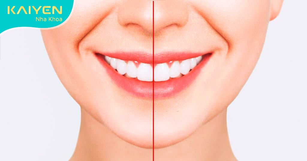 Khớp cắn của hàm răng là dựa trên trục đối xứng khuôn mặt