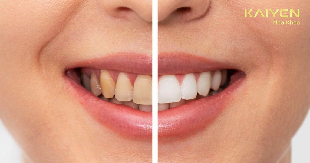 Răng trước và sau khi làm trắng răng tại nha khoa