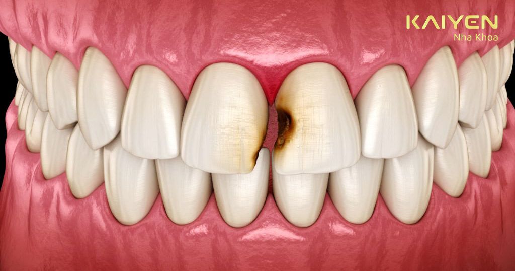 Phải điều trị sâu răng trước rồi mới thực hiện tẩy trắng răng