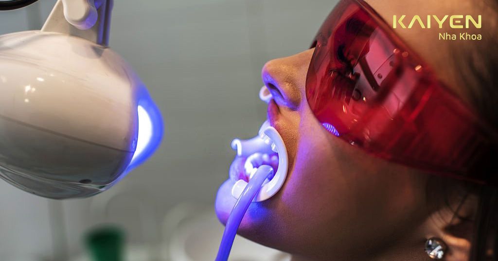 Phương pháp tẩy trắng răng bằng Laser tại nha khoa