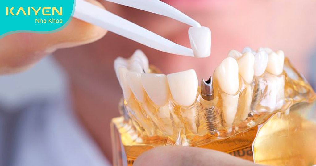 Phục hình răng sứ trên Implant