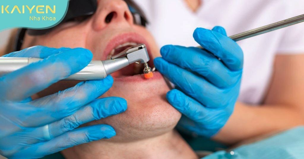 Lấy tủy răng mất bao lâu tủy thuộc vào tình trạng viêm và vị trí răng lấy tủy