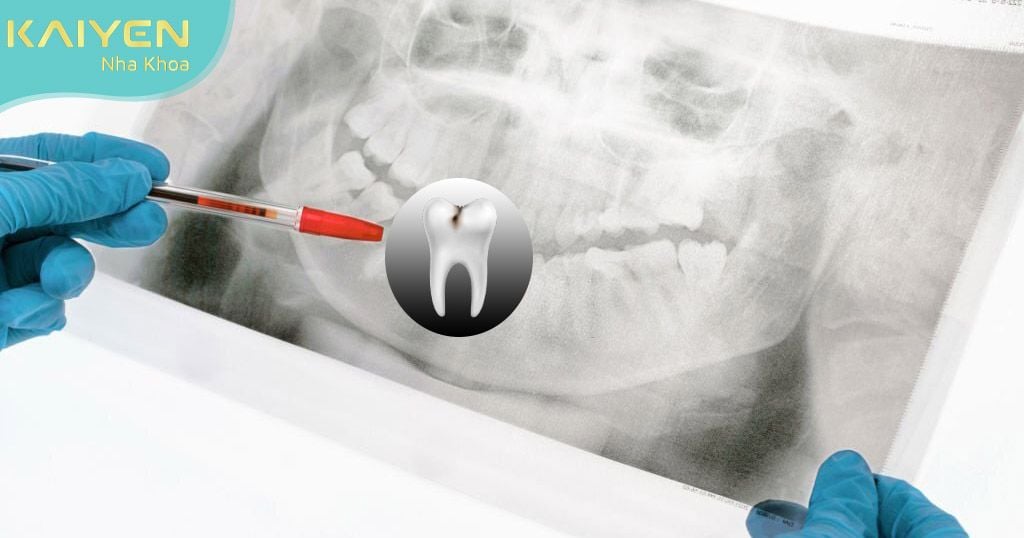 Kỹ thuật lấy tủy răng đòi hỏi tay nghề bác sĩ cao để tránh các biến chứng không mong muốn