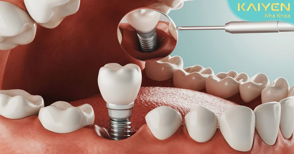 Implant nha khoa ngày càng được hoàn thiện cả về công dụng và tính thẩm mỹ