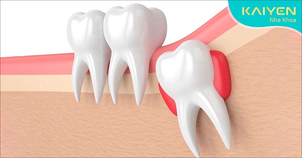 Răng số 8 là răng mọc cuối cùng trên cùng hàm, trong độ tuổi trưởng thành
