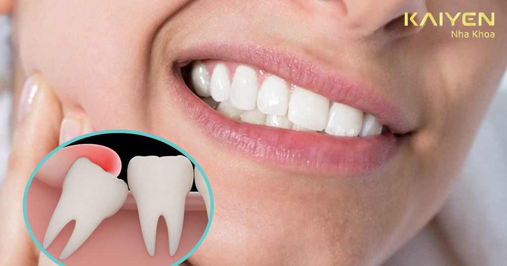 Những lưu ý khi nhổ răng khôn giúp giảm đau nhanh chóng
