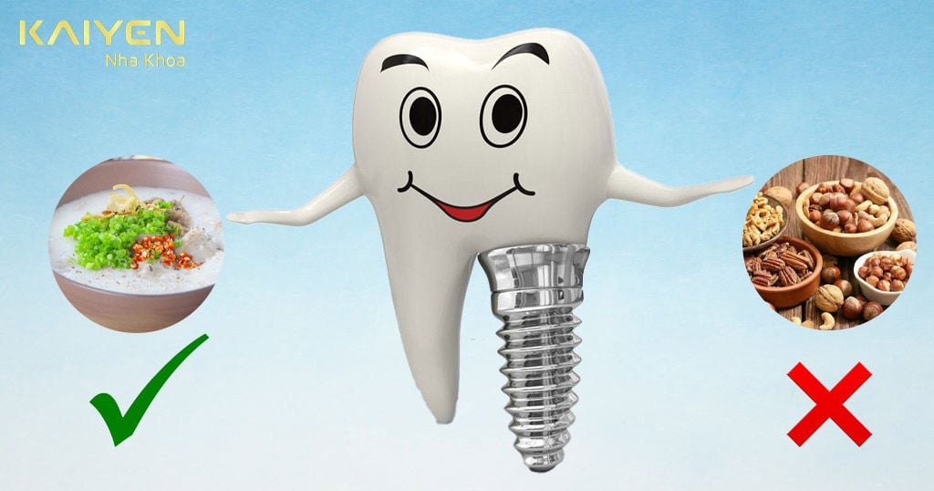 Lưu ý chế độ ăn uống sau khi cắm răng Implant
