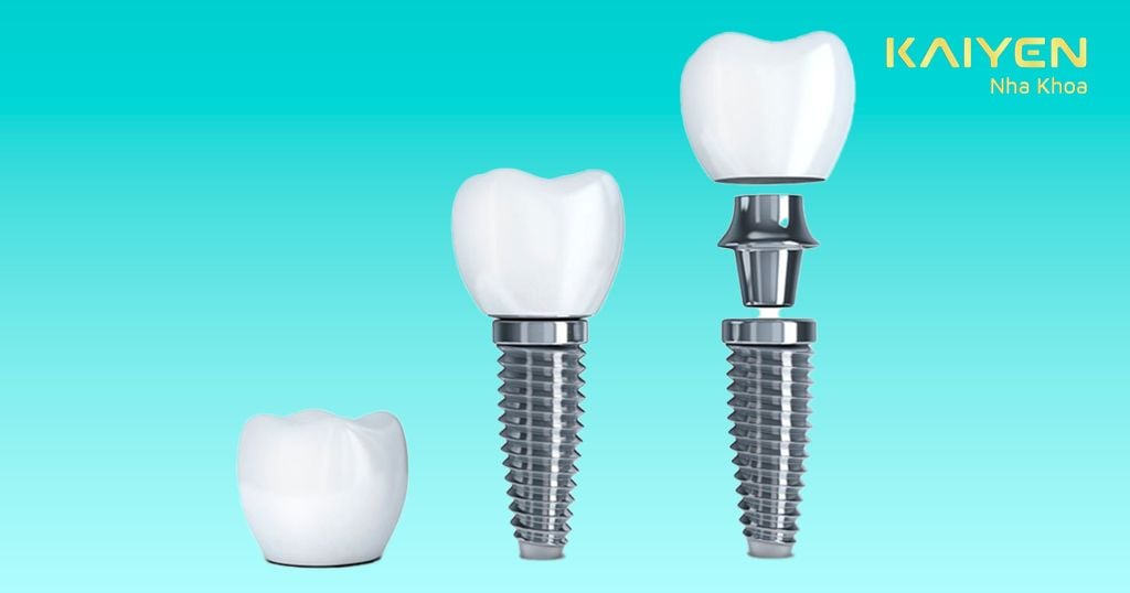 Răng Implant có cấu tạo gồm 3 phần: Trụ Implant, khớp nối Abutment và mão răng sứ