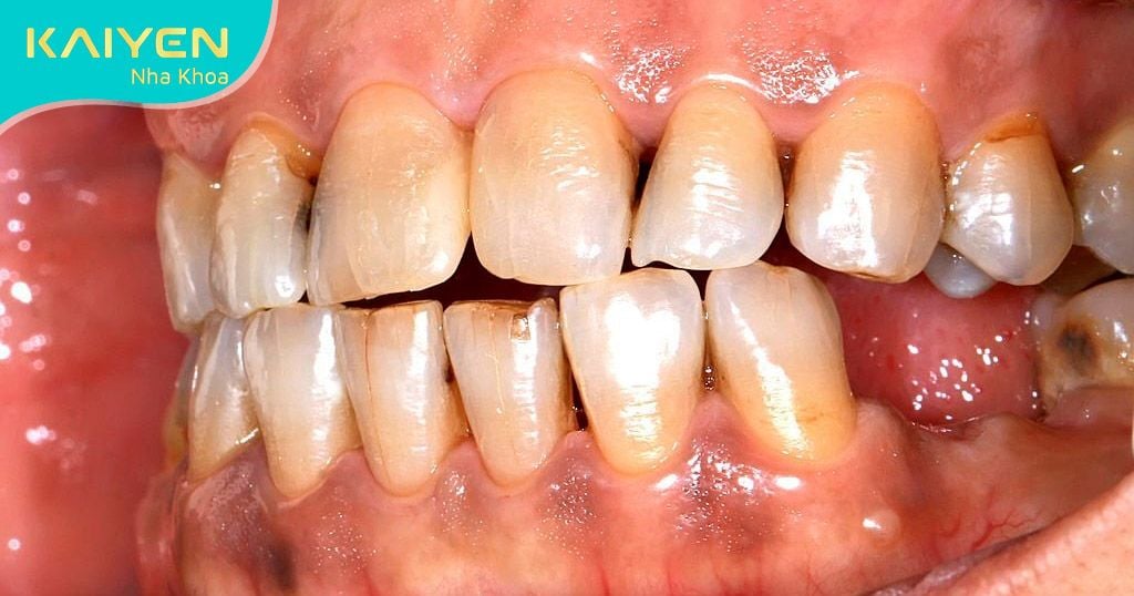 Mất 2 răng liền kề: Hậu quả và cách trồng răng tối ưu