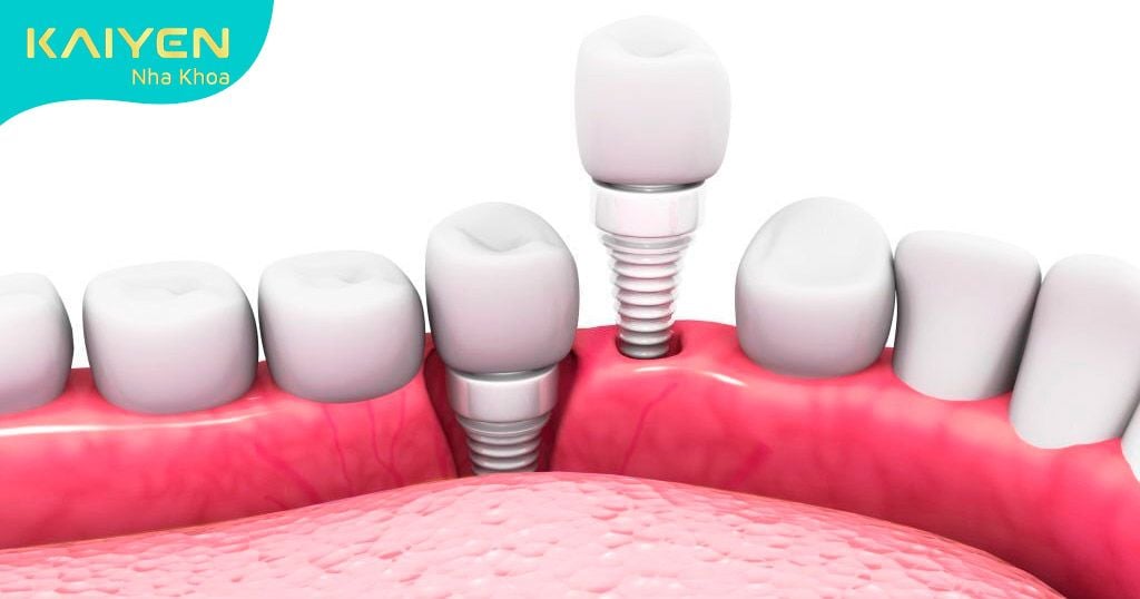 Cấy ghép Implant phục hình 2 răng mất tối ưu