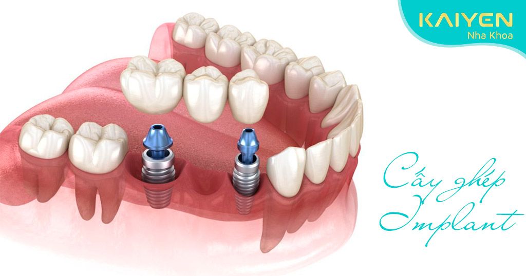 Trồng răng implant khi mất 3 răng liền kề