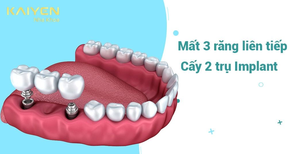[Giải đáp] Mất 3 răng liên tiếp chỉ cấy 2 trụ Implant có tốt không?