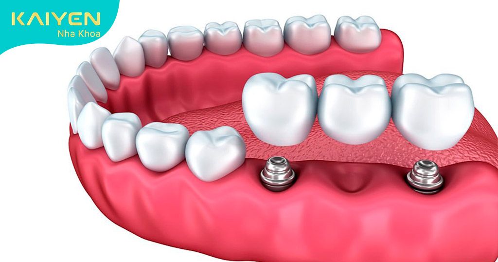 Cấy ghép Implant thay thế chân răng đã mất